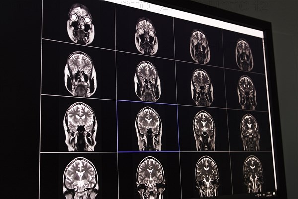 Black and white image of an MRI scan of the brain displayed on a screen