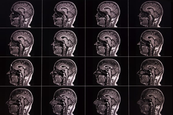 Several lateral MRI images of a brain, displayed in a matrix, show different layers