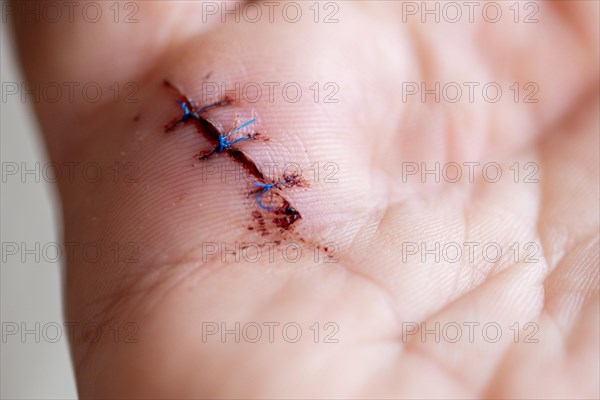 Operated snap finger, wound closed with three stitches, snap finger is the result of tendinitis of