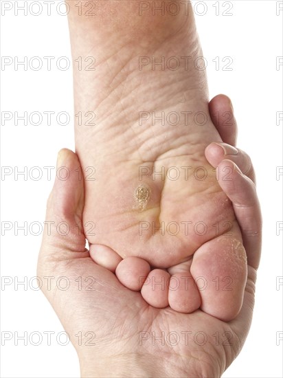 Dermatologist examining a foot for callus and dry skin, towards white
