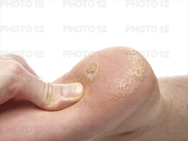 Dermatologist examining a foot for callus and dry skin, towards white