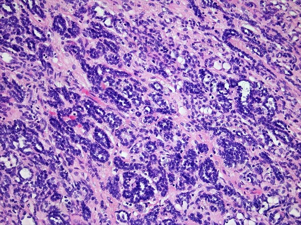 Wilms Tumor or Nephroblastoma of a childs kidney viewed at 200x magnification with hematoxylin and