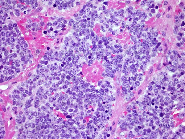 Microscopic image of a Neuroblastoma malignant tumor of the adrenal gland viewed at 300x