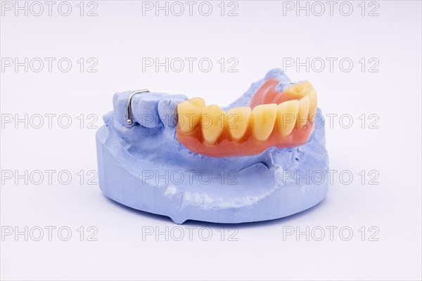 Removable denture of an upper jaw, denture, denture, dentist, dental impression