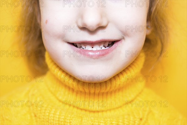 Girl shows her teeth-pathological bite, malocclusion, overbite. Pediatric dentistry and