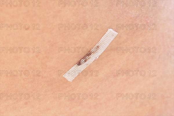 Close up of sterile wound closure strip used on cut after laparoscopy on woman's lower abdomen