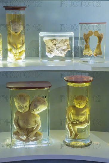 Anatomical collection, specimens, wet preparation. Skeleton, human, deformity, research, medicine,