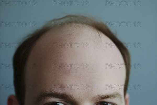 Close up of balding forehead of a middle aged man in front of blue background. Generative AI, AI