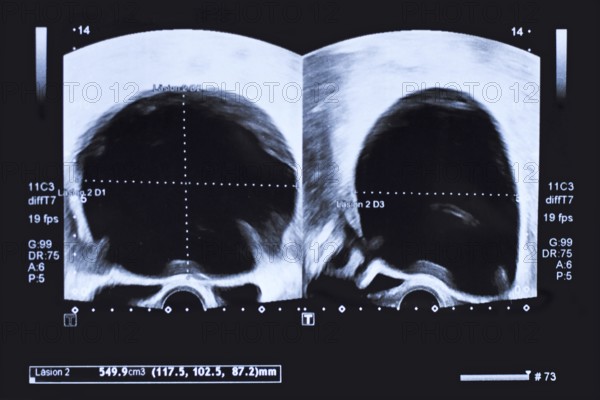 Ultrasound image of large round cyst in lower abdomen of woman printed on a piece of paper