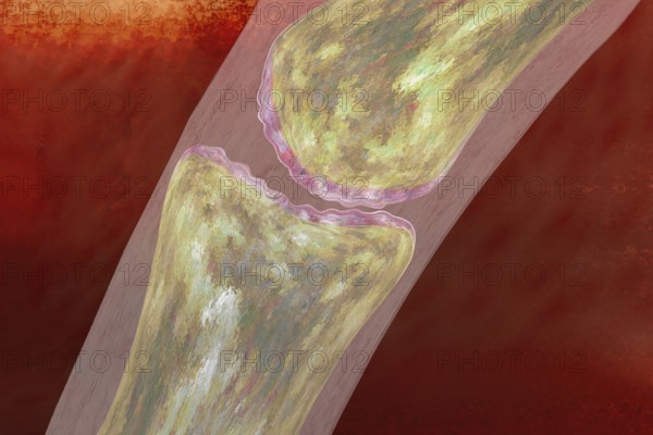 Joint inflammation is typical for rheumatism