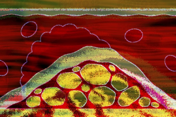Arteriosclerosis is a common vascular disease in which the arteries become narrowed and hardened by