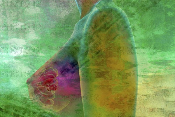 Tumour in a female breast, illustration medicine and health