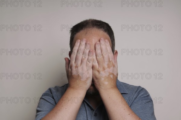man affected by Vitiligo skin condition hiding his face