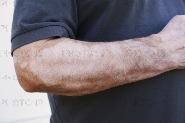 Vitiligo is a medical condition causing depigmentation of patches of skin