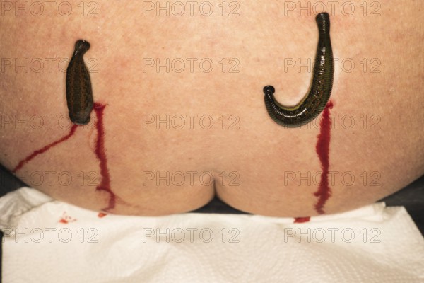 Two medicinal leeches (Hirudo medicinalis) were applied to the left and right of the spine, blood