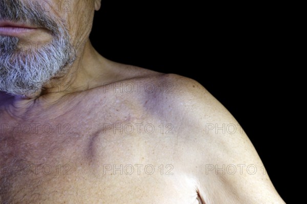 Elderly man with a pacemaker, studio photography with black background