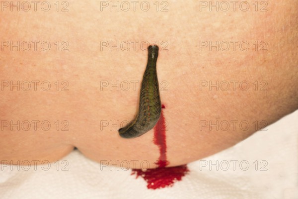 A medicinal leech (Hirudo medicinalis) has been applied to the right side of the spine and blood is