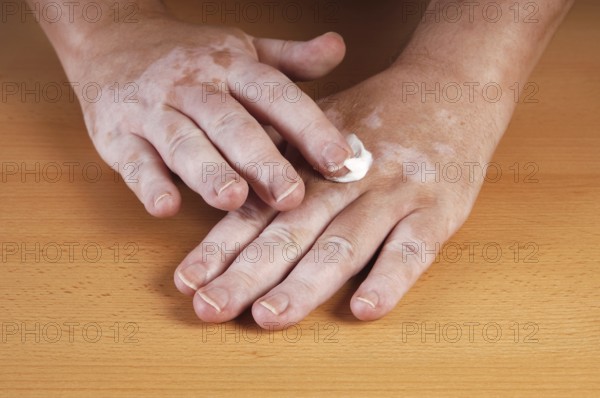 Vitiligo or white spot disease