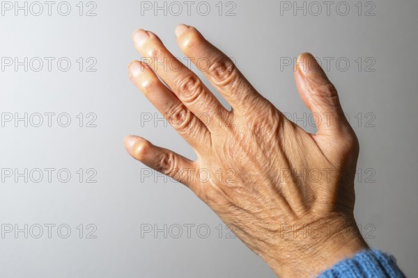 Close up view of a hand exhibiting swollen finger joints, emphasizing the painful effects of