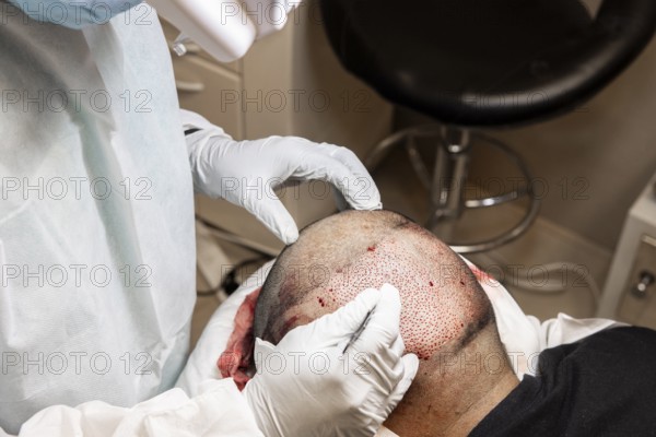 Doctor performing hair transplant. Surgeons in the operating room carry out hair transplant surgery