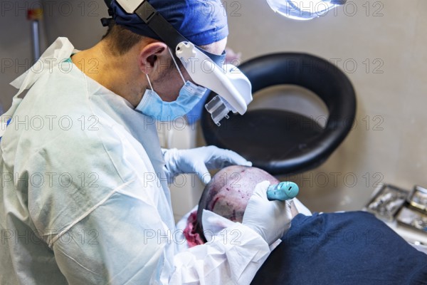 Doctor performing hair transplant. Surgeons in the operating room carry out hair transplant surgery
