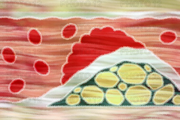 Arteriosclerosis is a common vascular disease in which the arteries become narrowed and hardened by