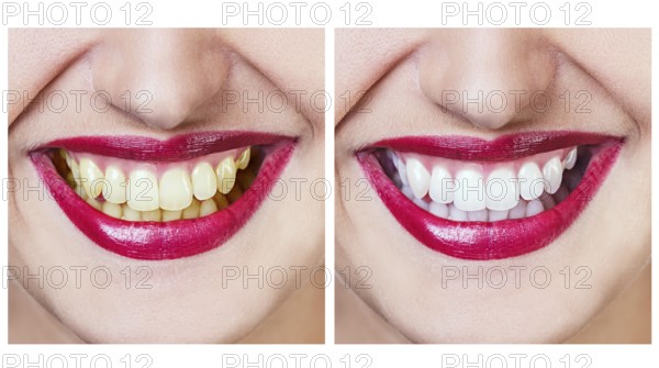 Whitening - bleaching treatment, before and after, woman teeth and smile isolated on white