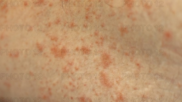 Close up to patches of inflammation called milk rash or atopic dermatitis on an adult caucasian