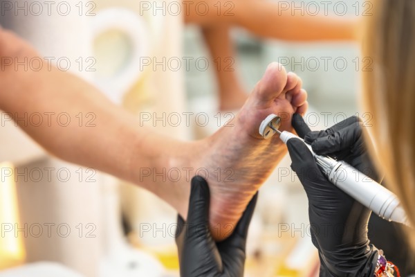 Close up of callus removal procedure being performed on foot by professional podiatrist using