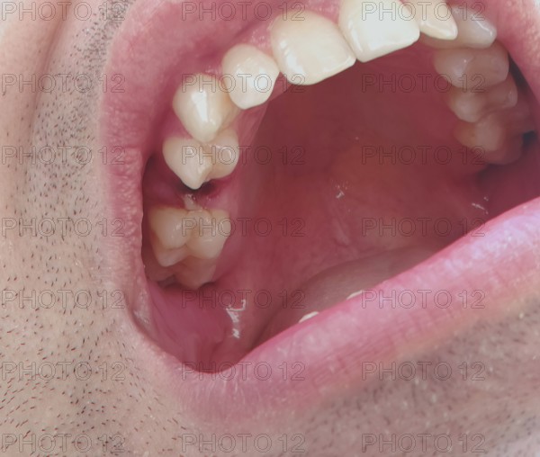Open mouth of a man with the place of a pulled out small molar tooth, healing of a wound in the