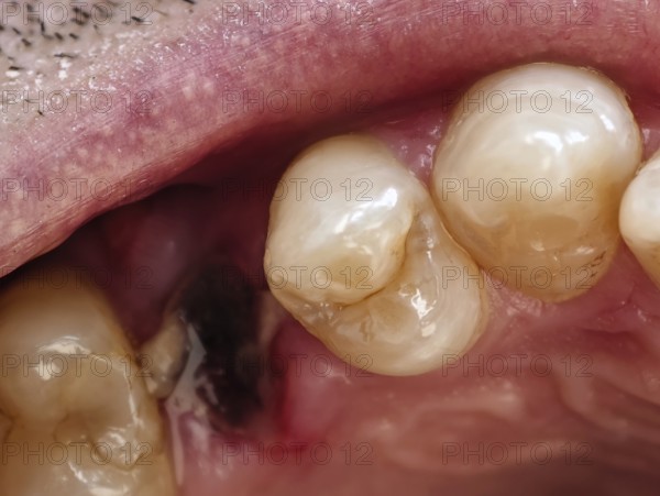 Open mouth of a man with the place of a pulled out small molar tooth, healing of a wound in the