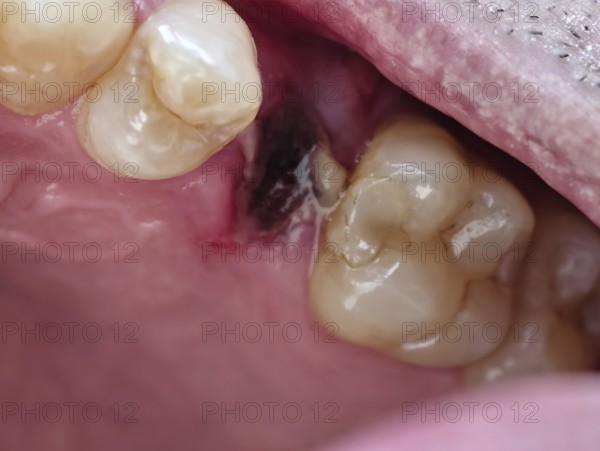 Open mouth of a man with the place of a pulled out small molar tooth, healing of a wound in the