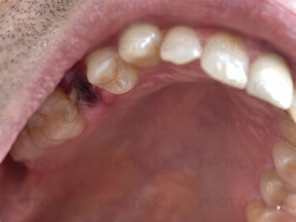 Open mouth of a man with the place of a pulled out small molar tooth, healing of a wound in the