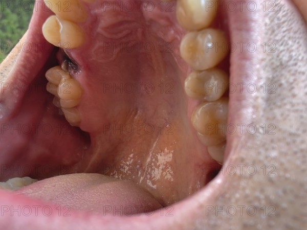 Open mouth of a man with the place of a pulled out small molar tooth, healing of a wound in the