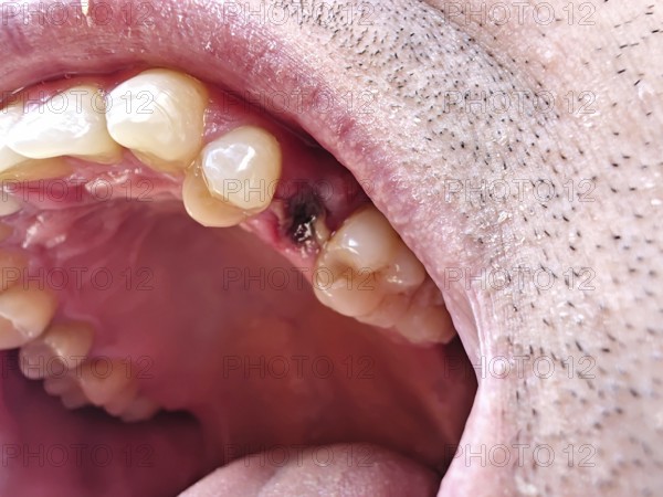 Open mouth of a man with the place of a pulled out small molar tooth, healing of a wound in the