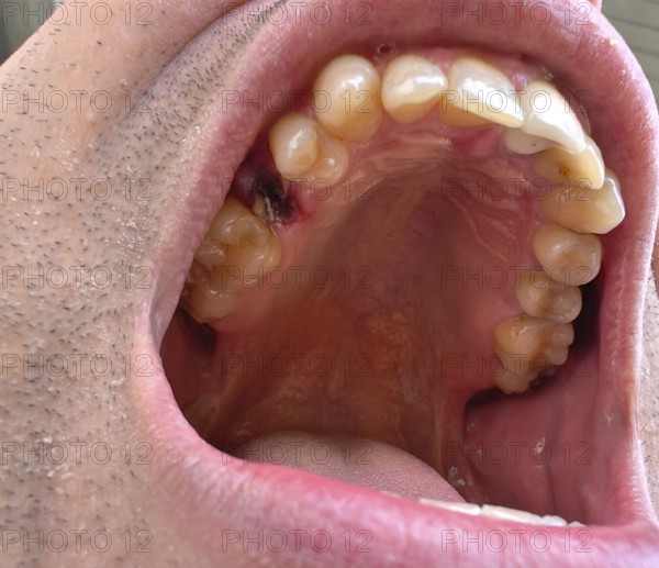 Open mouth of a man with the place of a pulled out small molar tooth, healing of a wound in the