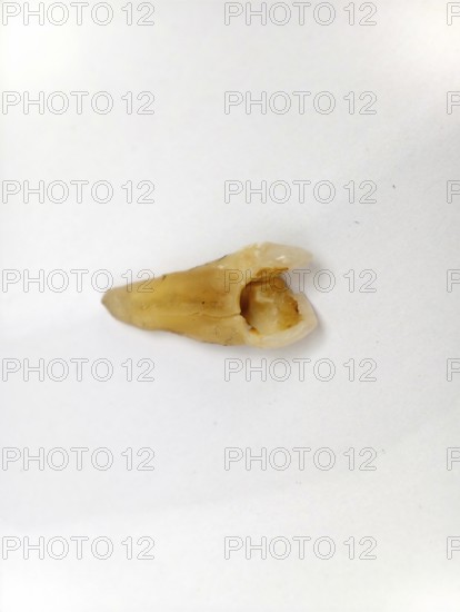 Pulled out, cracked, and damaged tooth, second premolar on a white background, Karaganda,
