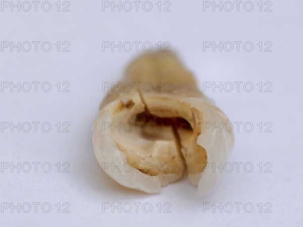 Pulled out, cracked, and damaged tooth, second premolar on a white background, Karaganda,