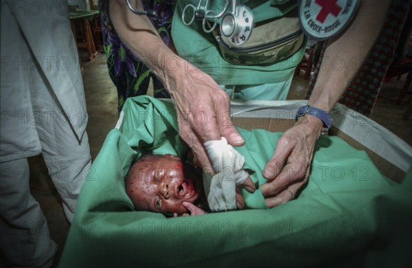 RWA Rwanda Kigali An injured Tutsi refugee child is receiving medical care in a makeshift hospital