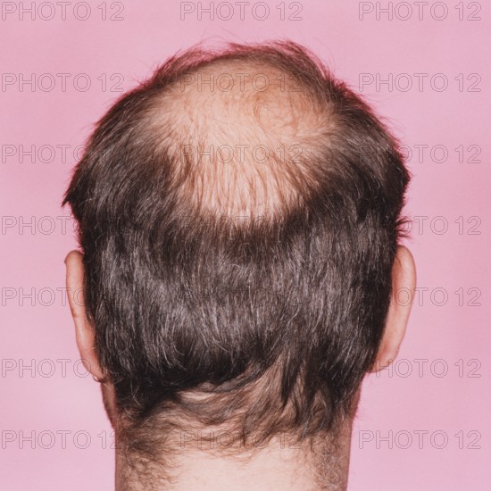 Close-up of the back of a man's head with a distinct bald head or hair loss