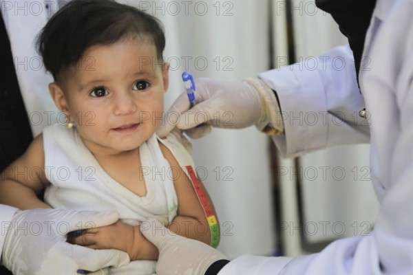 A doctor examines children's malnutrition inside a refugee camp. Malnutrition was measured using a