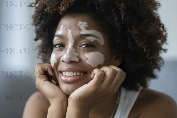 Beautiful smiling Black woman with vitiligo resting her hands near her face. Embracing beauty in