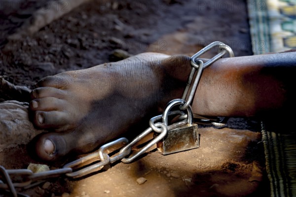A foot tied in thick chains symbolizes mental illness, Brobo, Ivory Coast