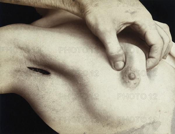 Patient, surgery, breast surgery, lump removal, tumor, metal surgical instrument inserted through