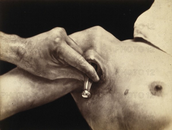 Patient, operation, a surgical instrument made of metal is inserted in an incision in the armpit,