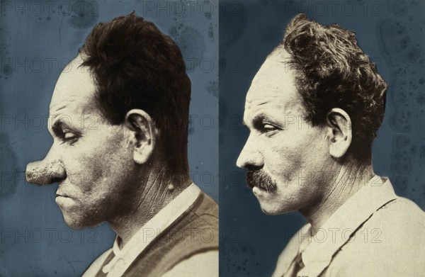 Cosmetic surgery, cosmetic surgery in front of, after. A man with a large, deformed nose who was
