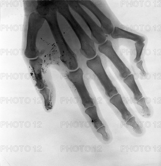Bone of a hand, deformed little finger, fracture of the joint, X-ray, X-ray, around 1900 medicine,