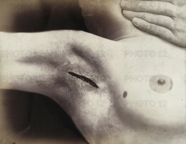 Patient, operation, an cut in the armpit to operation silverware, medicine, history of medicine,