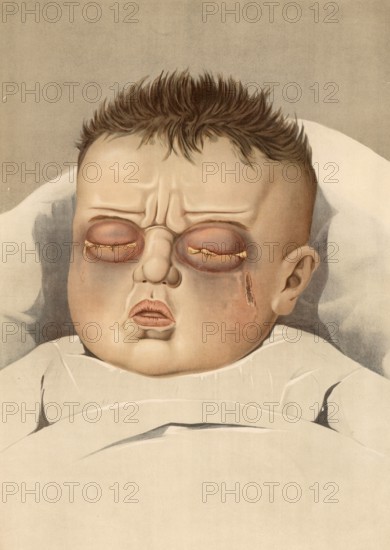 Medical illustration, clinical picture, venereal disease, tripper eye, symptoms of gonorrhea in the