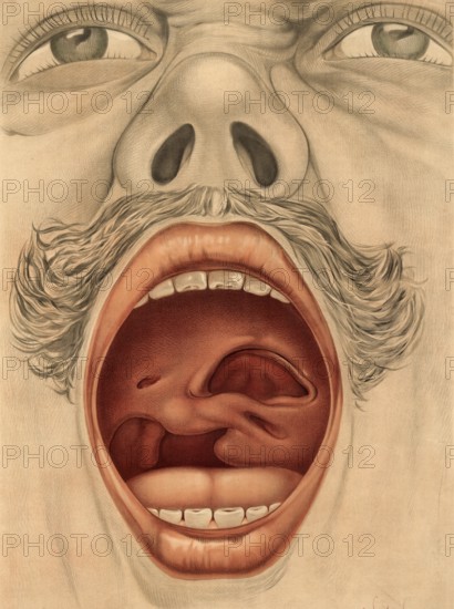 Medical illustration, clinical picture, venereal disease, palate perforation caused by syphilis,